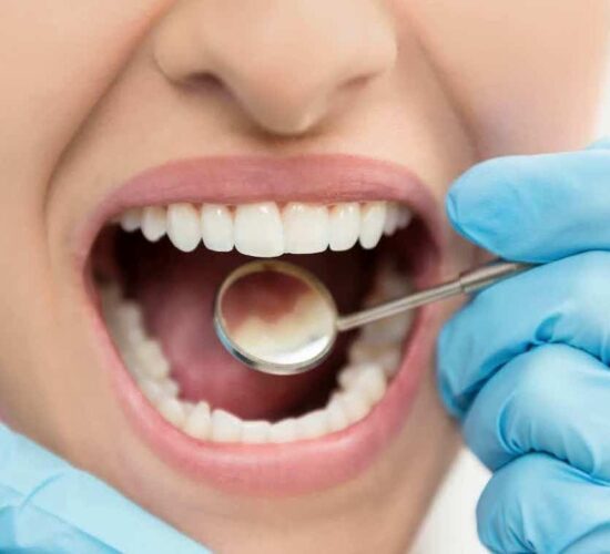 Tooth Colored Restorations