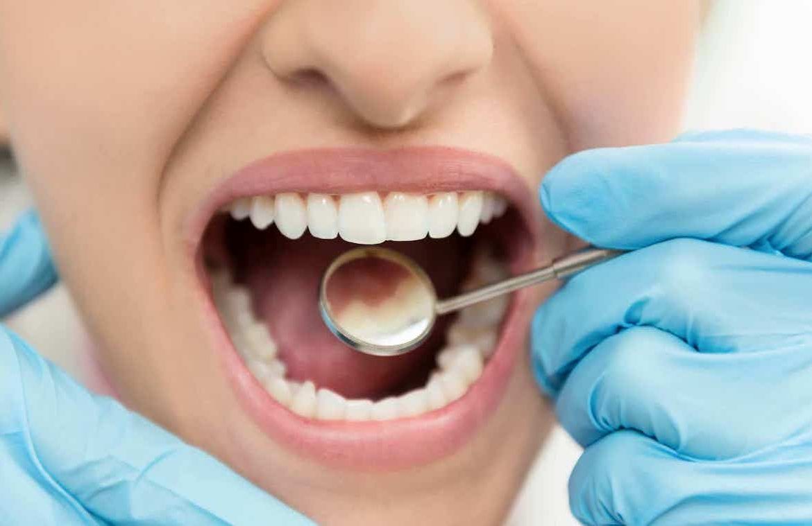 Tooth Colored Restorations