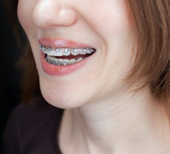 Braces