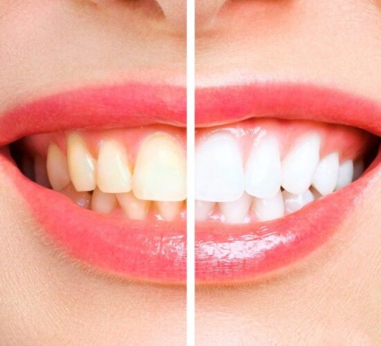 Teeth Whitening Procedures