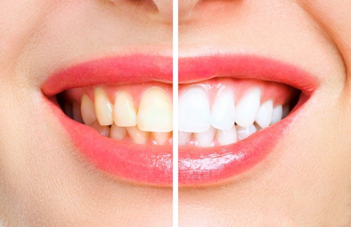 Teeth Whitening Procedures